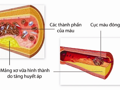 Điều trị bệnh tăng huyết áp như thế nào?