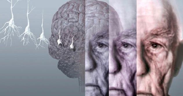 benh-Alzheimer.jpg